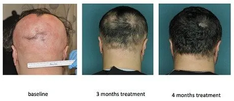 alopecia