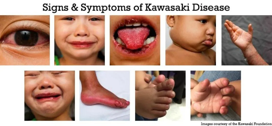 signs symptoms kawasaki disease