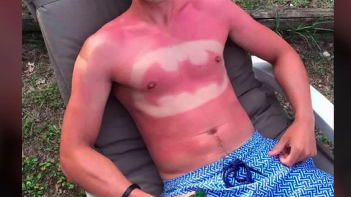 sunburn art