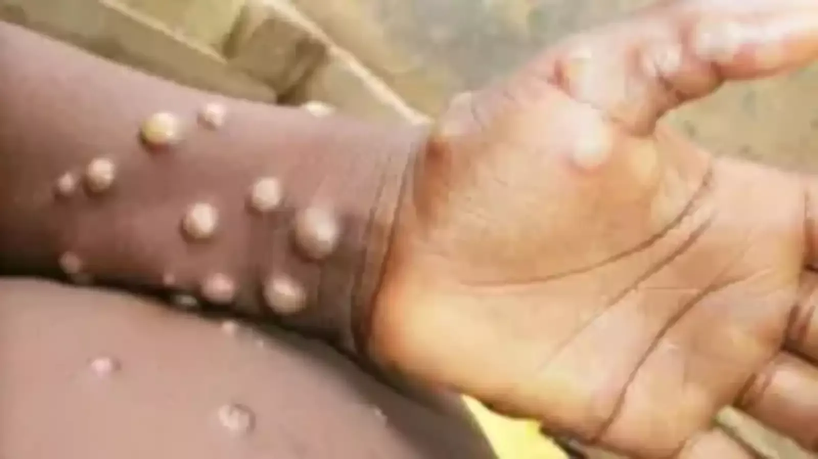 mpox outbreaks what you need to know about the global health emergencyjpg