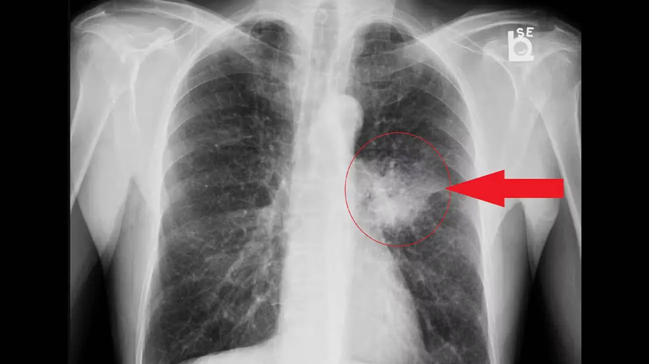 Adenocarcinoma-of-the-lung-body2