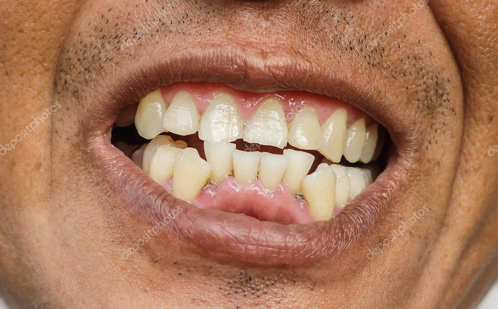 depositphotos_126319584-stock-photo-crooked-teeth-man-face