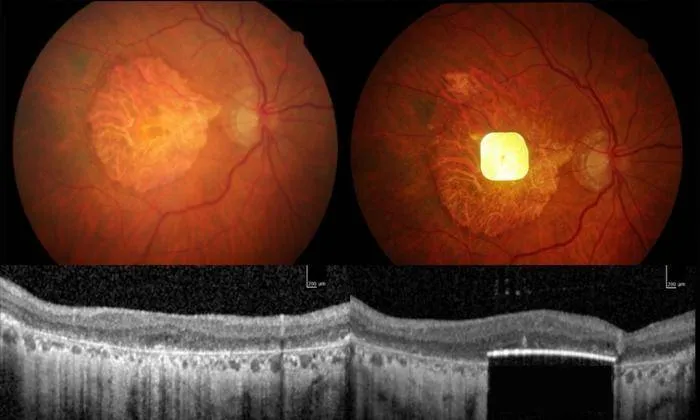 Low-Res_Implant in eye