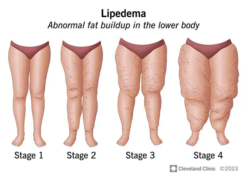17175-lipedema-illustration