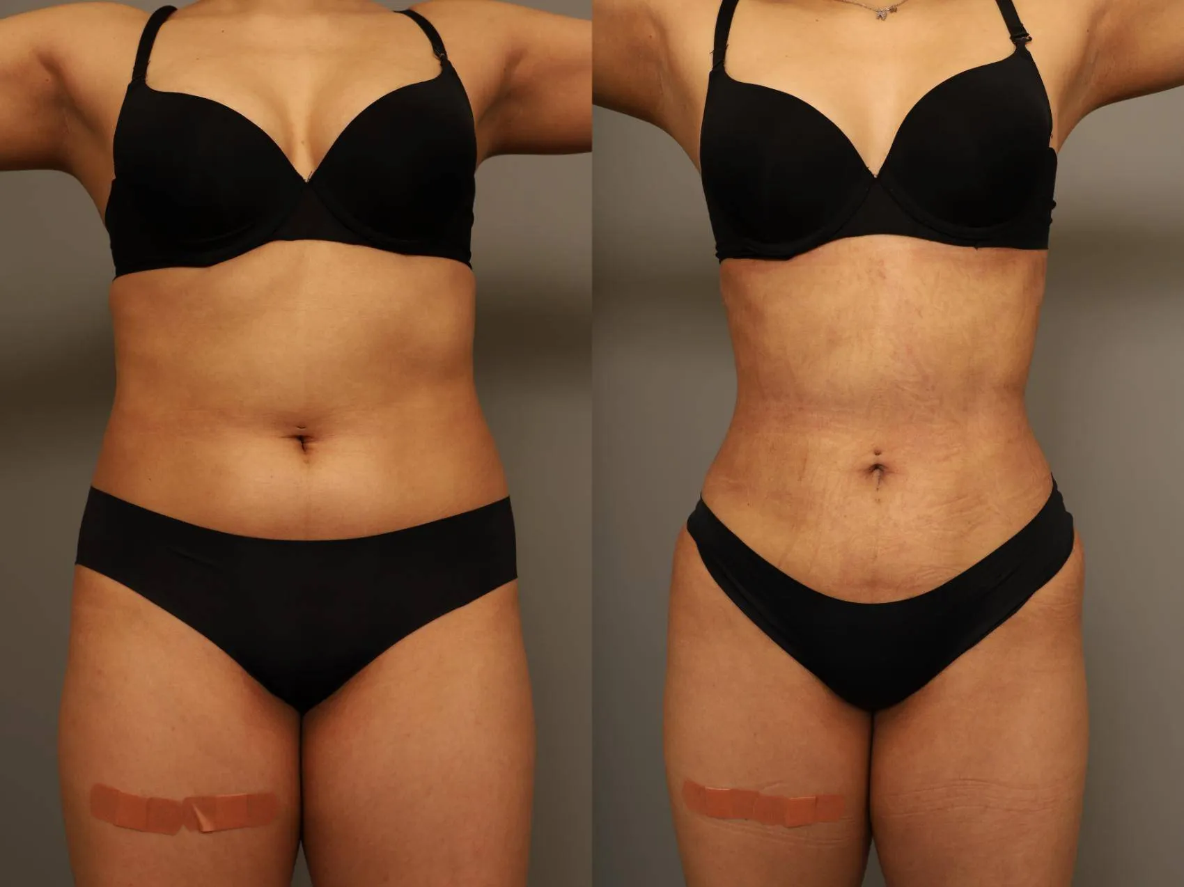 rib-remodeling--297-front-detail