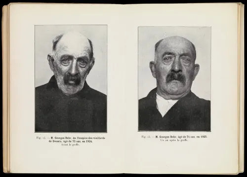 c389tude sur la vieillesse et la rajeunissement par la greffe wellcome l0068506