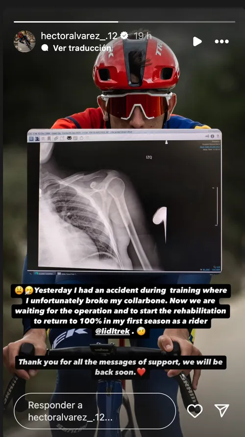 X-Ray of Alvarez´collarbone