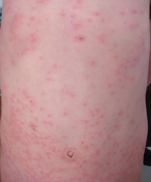 800px oak processionary rash