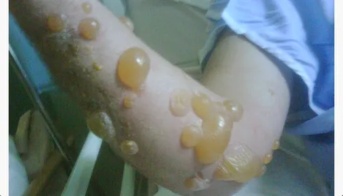 berenklauw brandwond