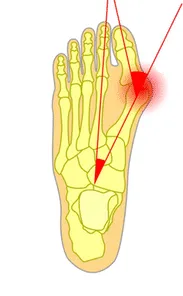 hallux valgus zehenknochen krumm 1
