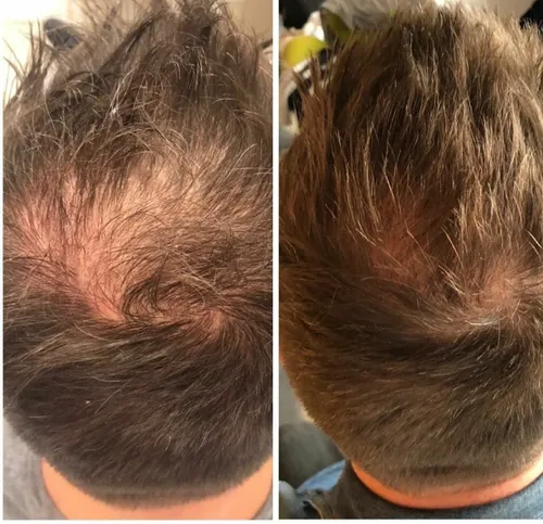 „Dr. Cyj Hair Filler“ metodas „Era Esthetic“ klinikoje / Organizatorių nuotr.