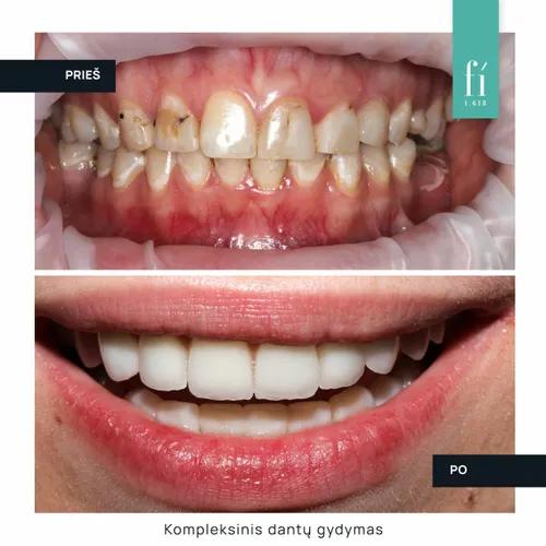 Kompleksinis dantų gydymas