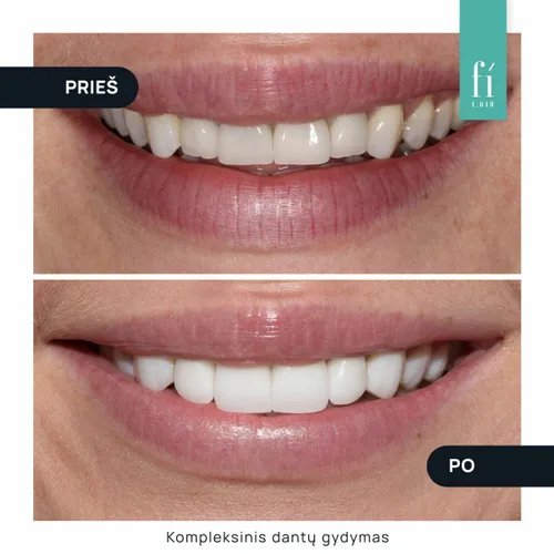 Kompleksinis dantų gydymas „Fi Clinica“ / Organizatorių nuotr.