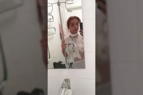 Toksinė epiderminė nekrolize serganti mergina