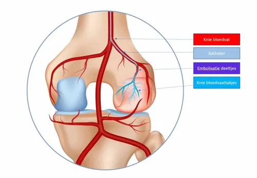 onderzoek-behandeling-voor-patienten-met-knie-artrose-zonder-operatie-1552x1080