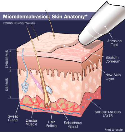 microdermabrasie huid