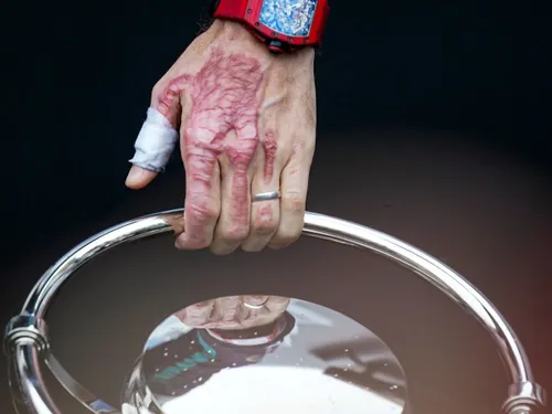 Romain Grosjean forbrændte hånd