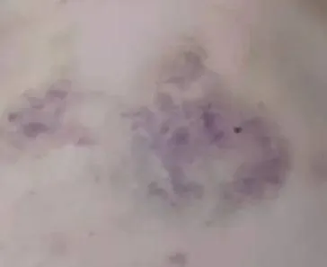 <i>Et af de blå mærker, Larissa Ferrari fik af den franske fodboldspiller</i>