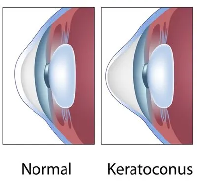 keratoconus