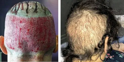 overharvesting-results-from-a-bad-hair-transplant
