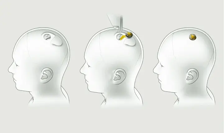 neuralink installation