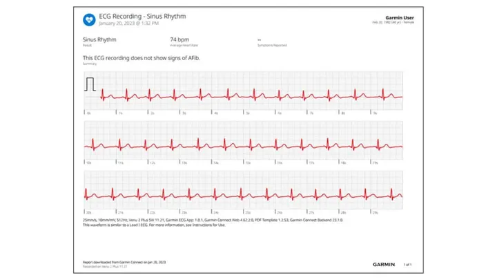 ecg recording on garmin watch