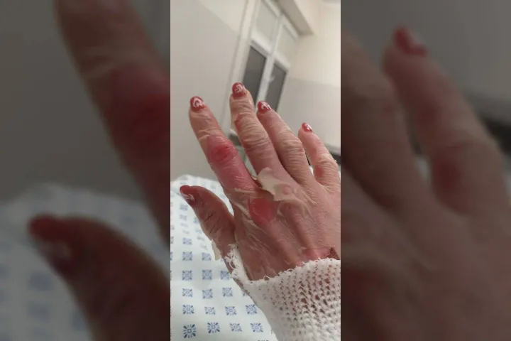 Toksinė epiderminė nekrolizė