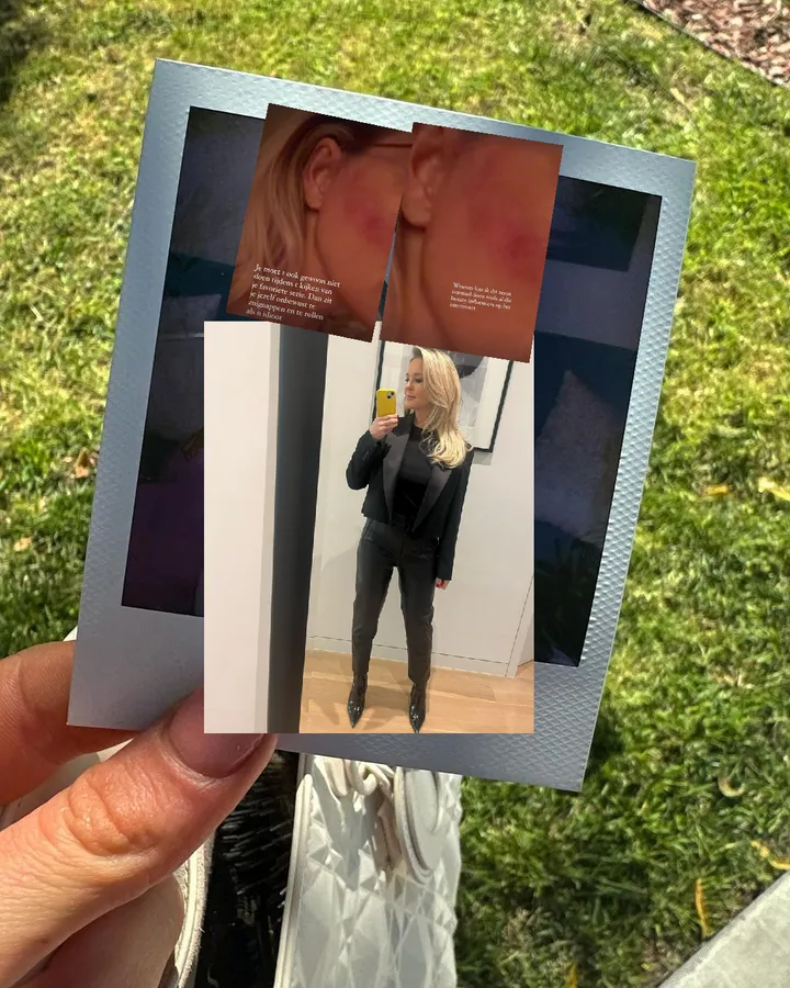 chantal janzen heeft rode vlek gekregen door te veel zuigkracht te gebruiken