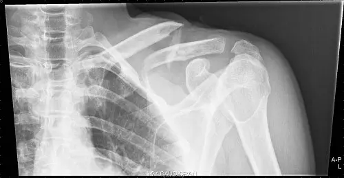 jaap van lagen clavicula rx 500